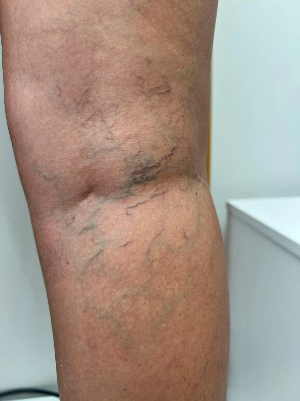 Pernas com varizes antes do tratamento Espuma e Laser Transdérmico